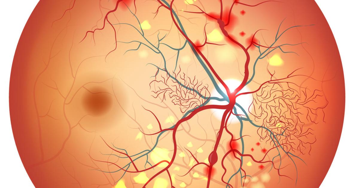 Ангиопатия сосудов сетчатки что это. Гипертоническая ретинопатия. Ангиопатия сетчатки глазное дно. Гипертоническая ангиопатия сетчатки. Диабетическая ангиопатия сетчатки.