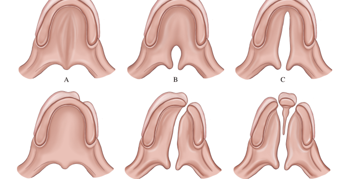 In the treatment of cleft lip and palate, one operation is often not